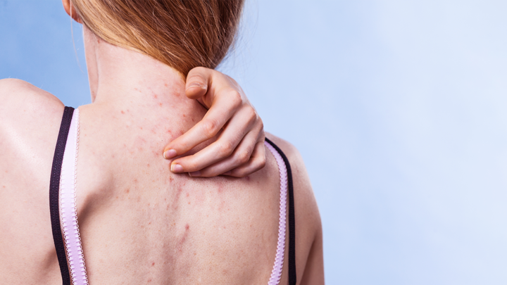 Woman scratching the pimples on her back