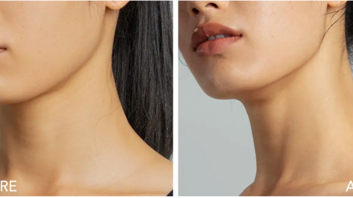 microcorrientes lifting facial